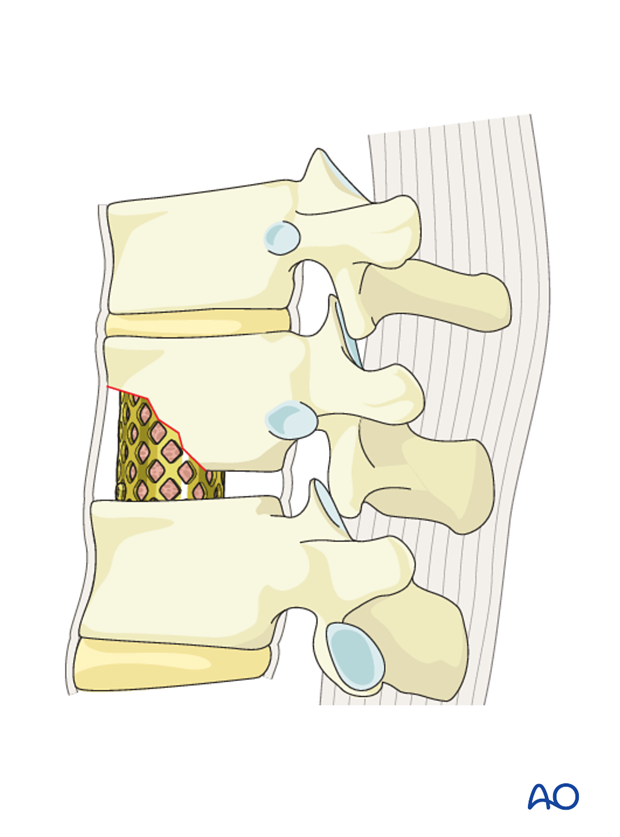 Thoracic and lumbar fractures: Anterior stabilization