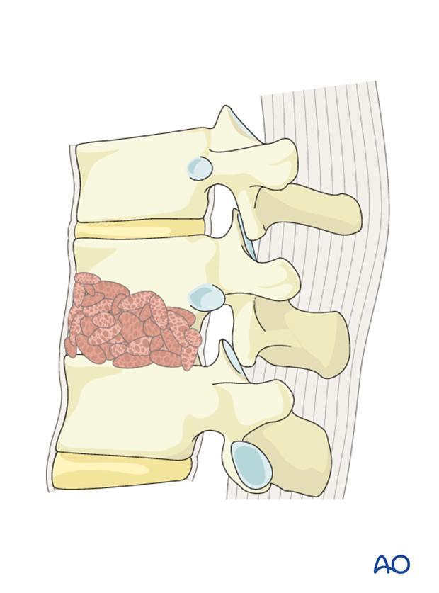 Thoracic and lumbar fractures: Anterior stabilization