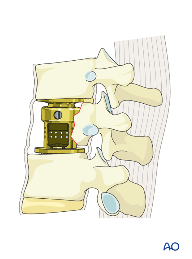 Thoracic and lumbar fractures: Anterior stabilization