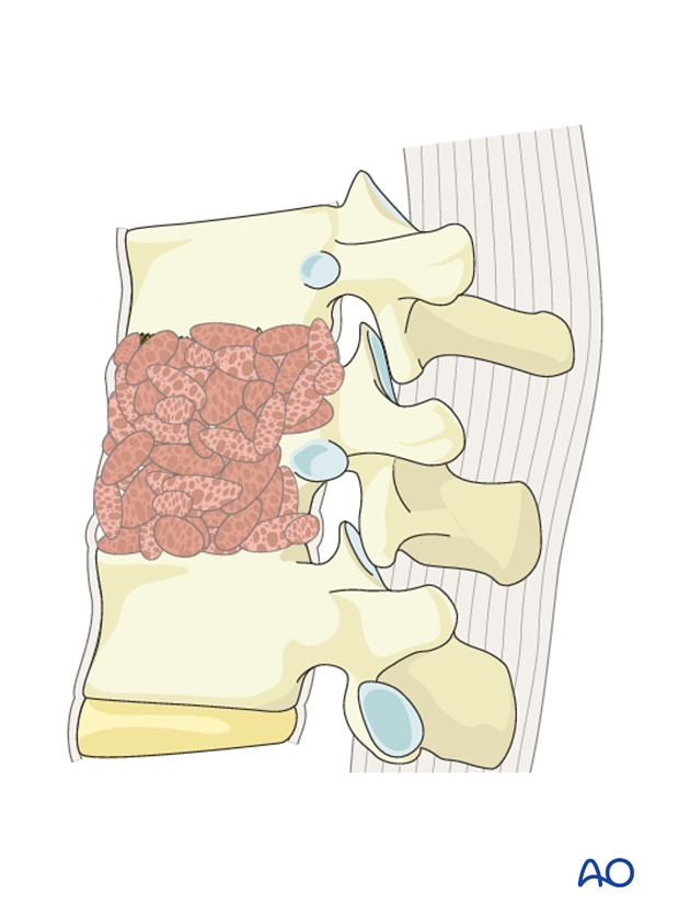 Thoracic and lumbar fractures: Anterior stabilization