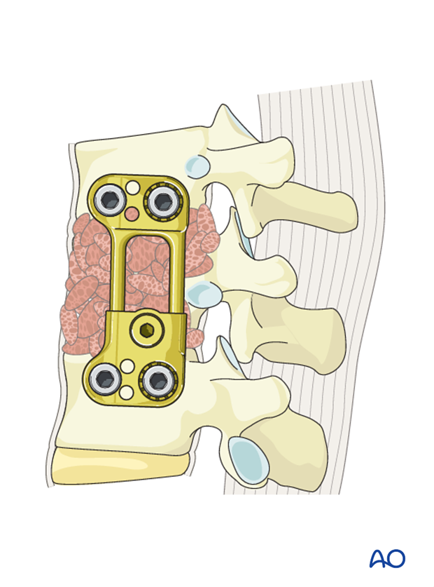 Thoracic and lumbar fractures: Anterior stabilization