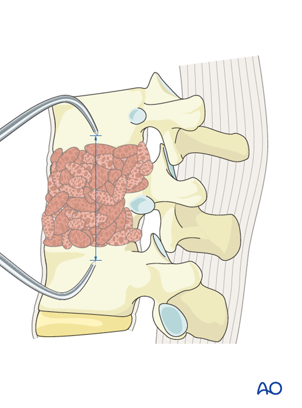 Thoracic and lumbar fractures: Anterior stabilization