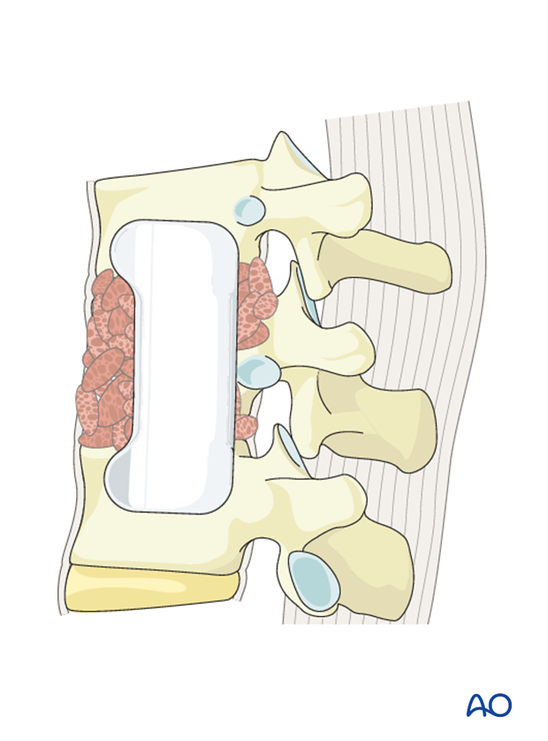 Thoracic and lumbar fractures: Anterior stabilization