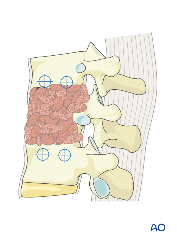 Thoracic and lumbar fractures: Anterior stabilization