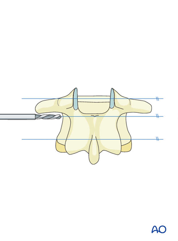 Thoracic and lumbar fractures: Anterior stabilization