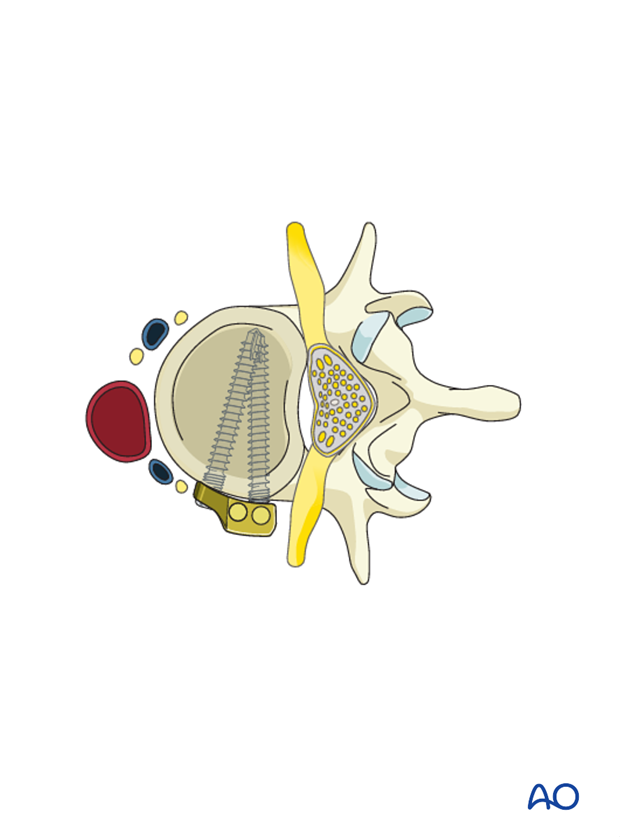 Thoracic and lumbar fractures: Anterior stabilization