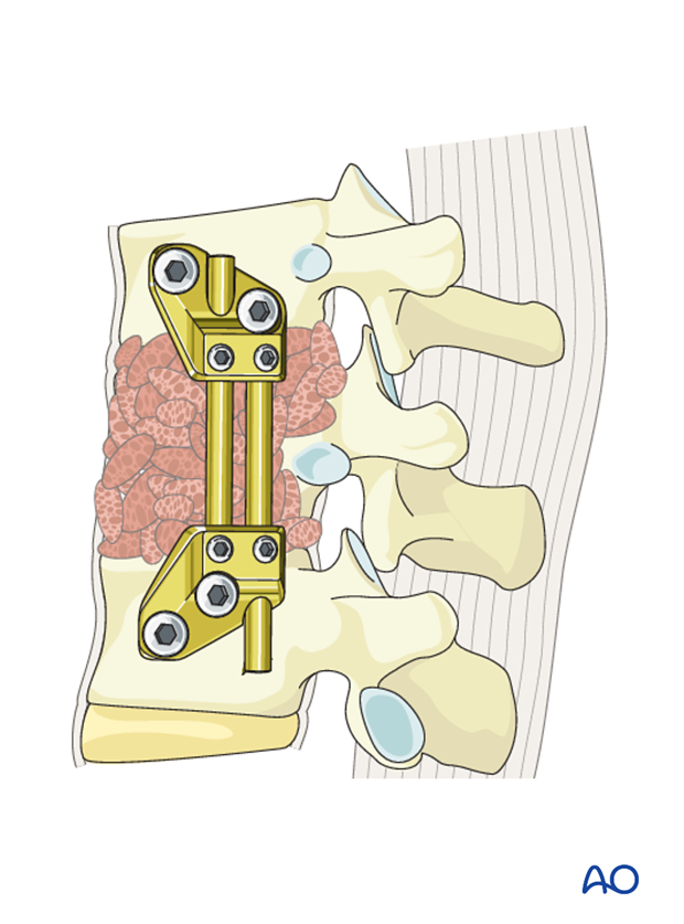 Thoracic and lumbar fractures: Anterior stabilization