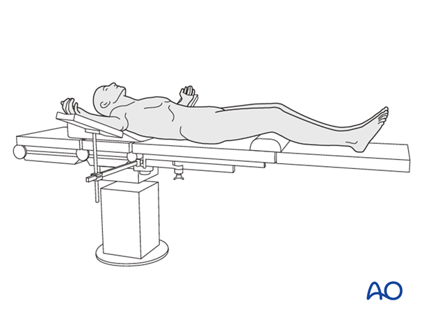 Thoracic and lumbar fractures: Mini open retroperitoneal approach (L4-S1)