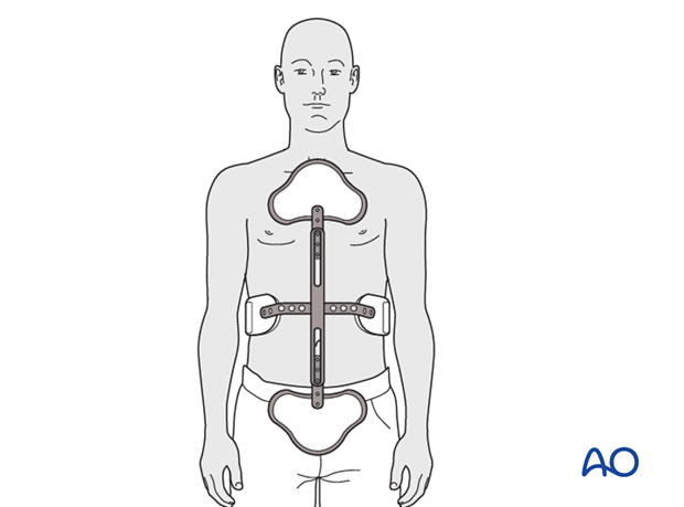 Thoracic and lumbar fractures: Aftercare for nonoperative treatment