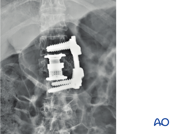 Thoracic and lumbar fractures: Aftercare for anterior procedures