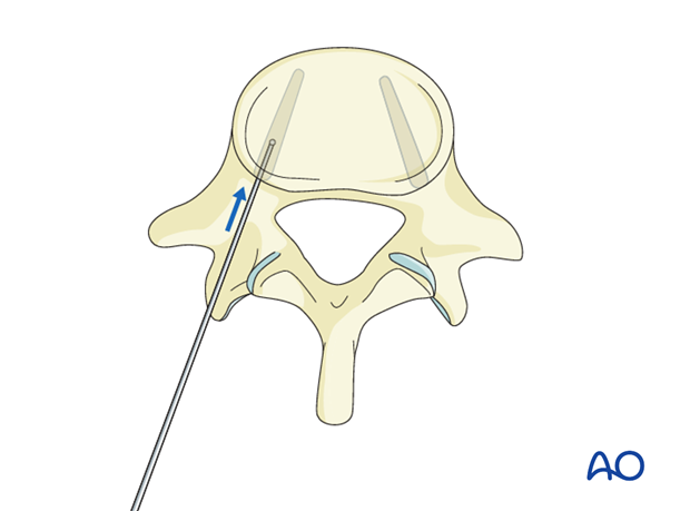 pedicle screw insertion