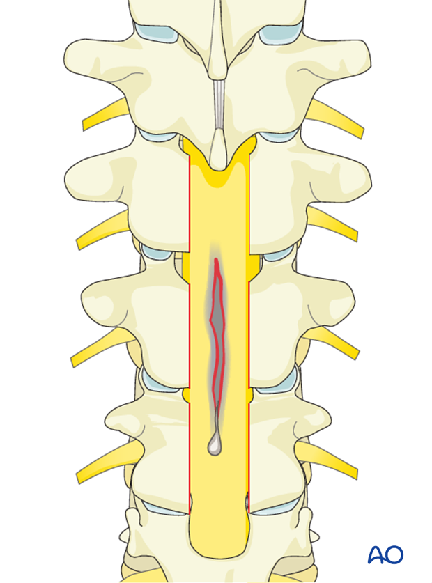 repair of dural laceration