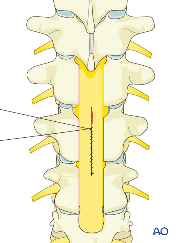 repair of dural laceration