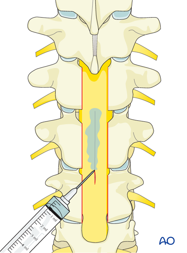 repair of dural laceration