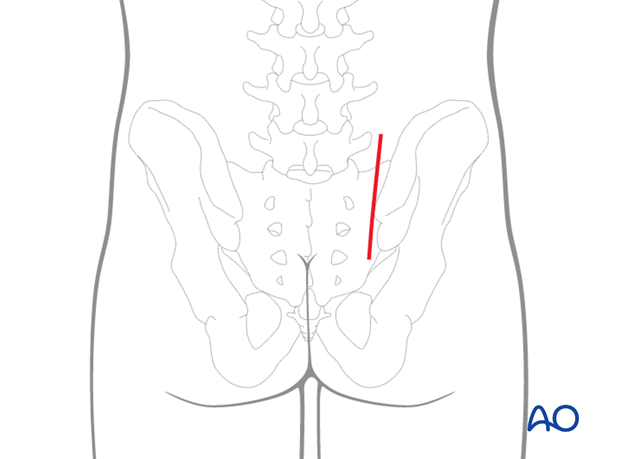 posterior paramedian approach to the sacrum