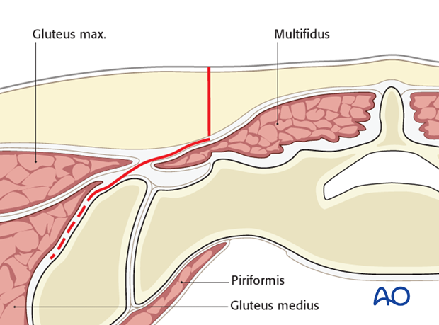 posterior paramedian approach to the sacrum