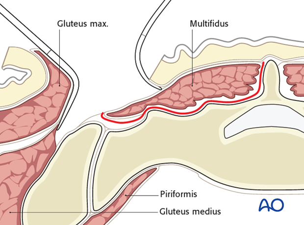 posterior paramedian approach to the sacrum