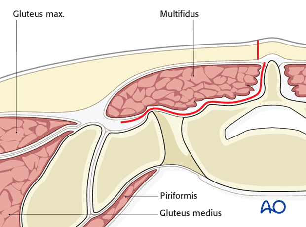 posterior midline approach to the sacrum