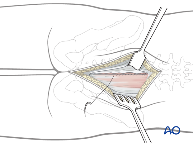 posterior midline approach to the sacrum