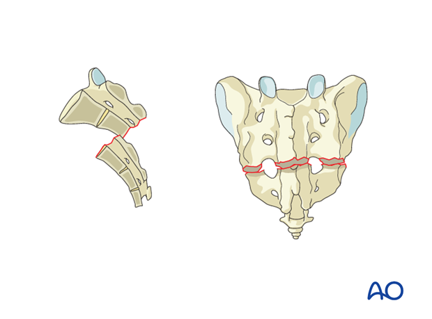 orif sacral alar plating