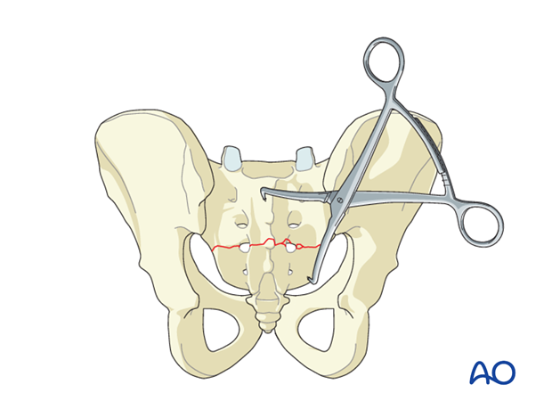 orif sacral alar plating