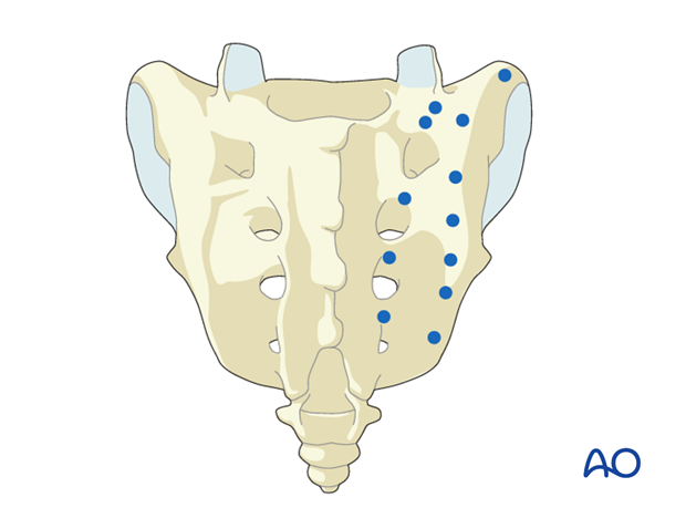 orif sacral alar plating