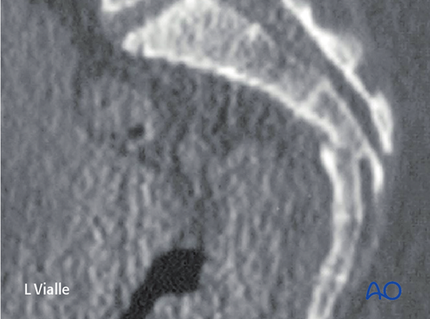 orif sacral alar plating