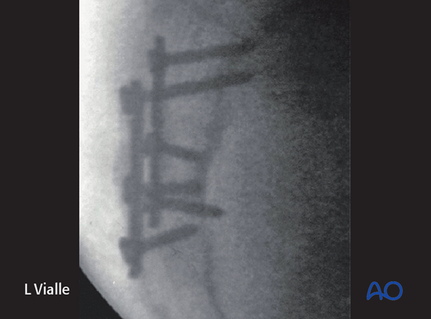 orif sacral alar plating