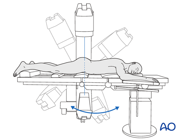 spinopelvic fixation