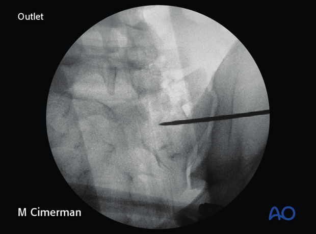 iss fixation