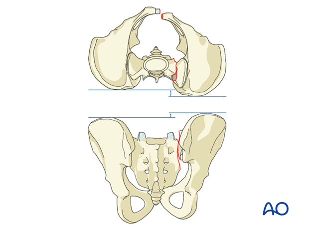 iss fixation