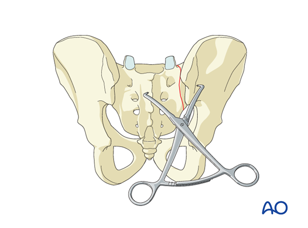 iss fixation