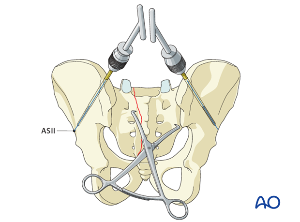 iss fixation