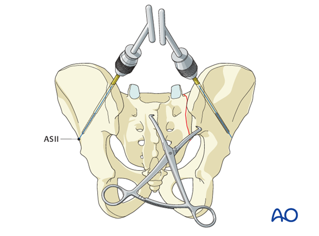 iss fixation