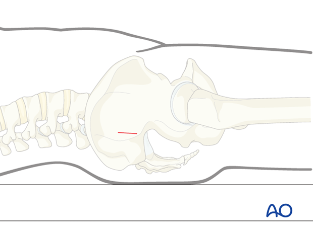 iss fixation