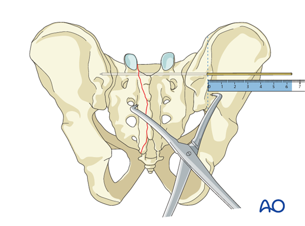 iss fixation