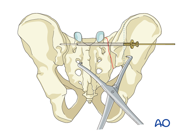 iss fixation