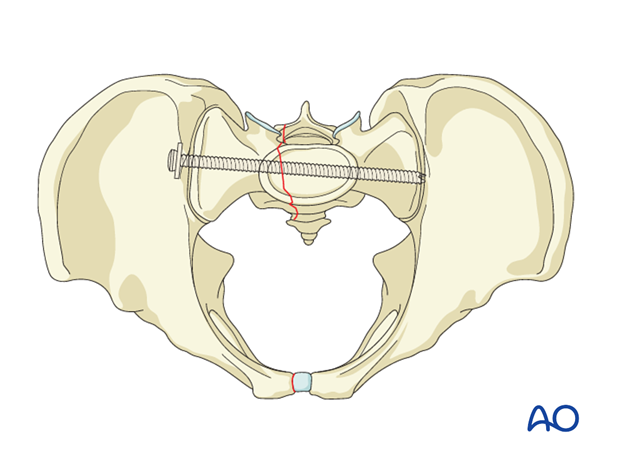 iss fixation