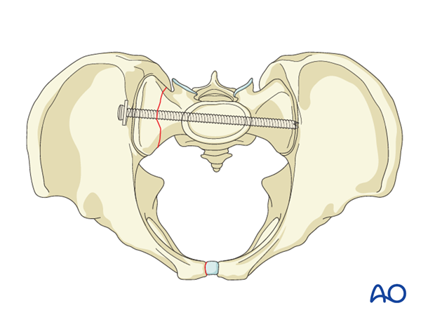 iss fixation