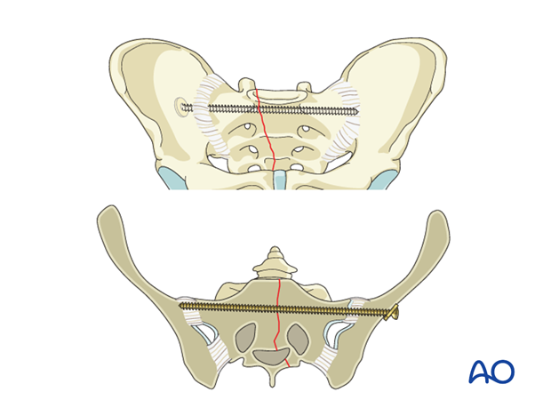 iss fixation