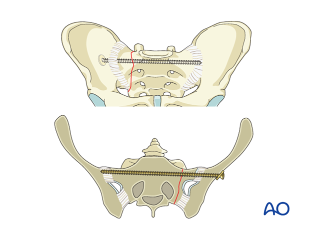 iss fixation