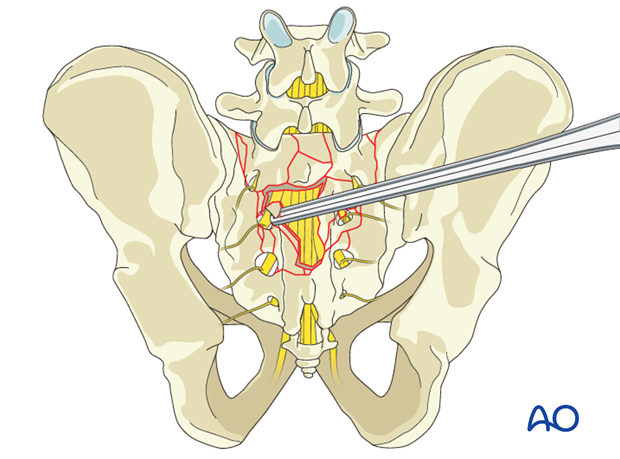 laminectomy