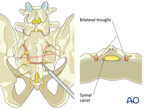 laminectomy