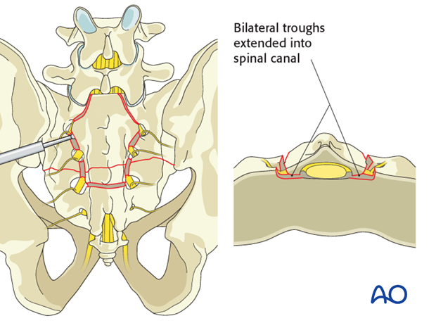 laminectomy