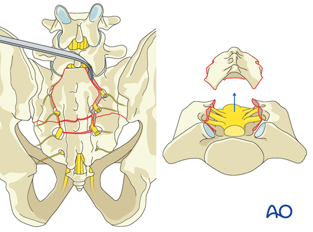 laminectomy