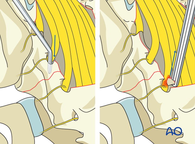 laminectomy