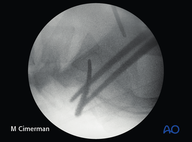 iliosacral screw insertion