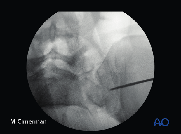 iliosacral screw insertion