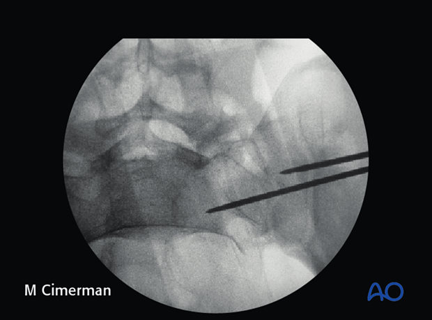 iliosacral screw insertion