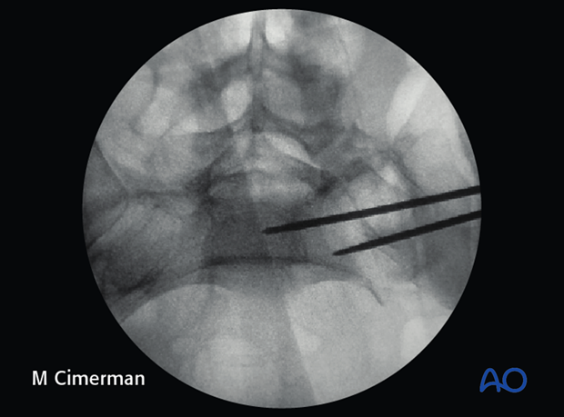 iliosacral screw insertion